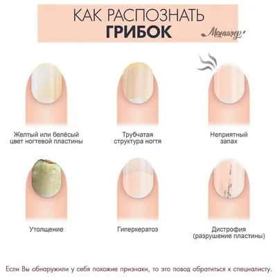 Анонихия - это болезнь ногтей на руках или ногах, которая выражается в  отсутствии ногтевой пластины на пальцах. Может проявиться… | Instagram