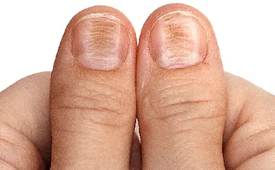 Как определить болезнь по ногтям? Ногти скажут всё о вашем здоровье! |  Школа Векторного Массажа и Соматики | Дзен