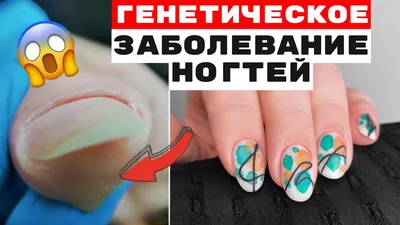 Изменение цвета ногтей — болезни при изменении цвета ногтей