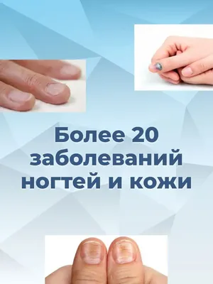 Не грибковые заболевания ногтей! | ВКонтакте