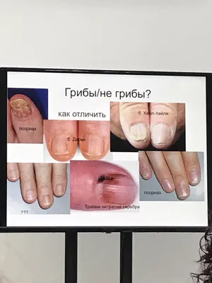 14 дефектов ногтей, которые говорят о серьезных заболеваниях