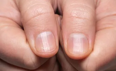 Сыворотка для восстановления ногтей от грибков, онихомикоз, паронихии,  лечение против грибковой инфекции ногтей, пальцев, ногтей, ногтей, грибка  для рук и ног, уход за ногами 30 г | AliExpress