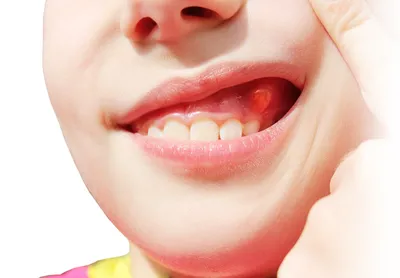 Что делать если передние молочные зубы не выпадают в 7 лет, а новые растут