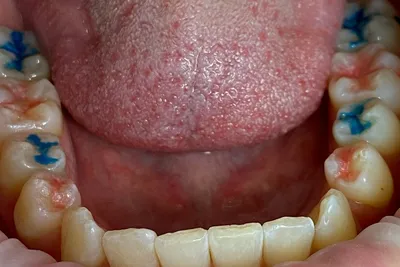 Что делать, если опухла (воспалилась) десна возле зуба и болит, отдавая в  зубы?