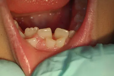 Прорезывание зубов у детей: симптомы и осложнения