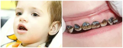 Детские зубные коронки - детская стомалогия Nikadent Family