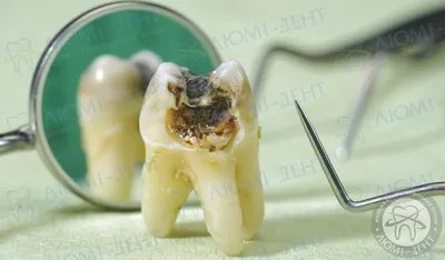 Можно ли удалять молочные зубы ребенку в домашних условиях без стоматолога