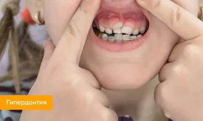 Как исправить кривые зубы: методы без брекеты, причины и способы лечения в  стоматологии