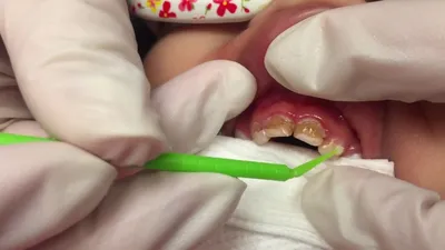 Виды зубной боли
