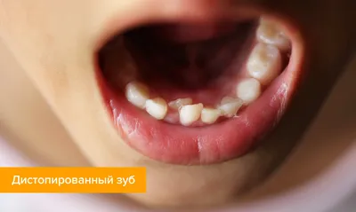 С какого возраста можно удалять молочные зубы детям?
