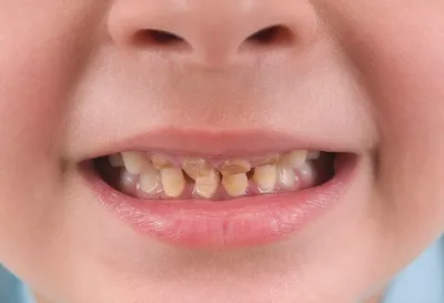 Плохие молочные зубы: причины – статьи детской стоматологической клиники  «Мартинка»