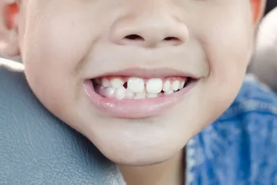 Признаки больных зубов у ребенка