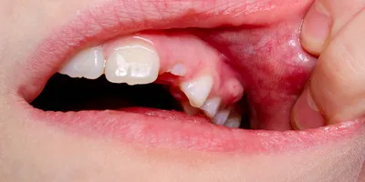 Глазные зубы - это какие, где находятся, симптомы при прорезывании, удаление