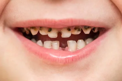 Гнилые зубы у детей, почему гниют и что делать