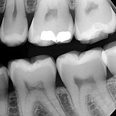 Порядок прорезывания зубов у детей - Евромед Дентал