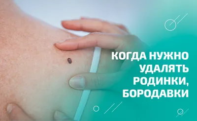Зачем удалять родинки, бородавки. Какой способ удаления лучше