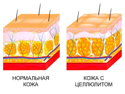 Основные методы борьбы с целлюлитом на бедрах, ягодицах и животе |  Косметология и эстетическая медицина | Дзен