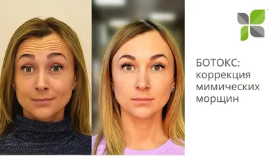 Инъекции Ботокса Позняки - цены на инъекции Botox в Киеве