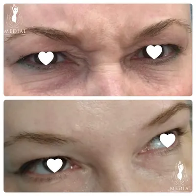 Ботокс глаз 💉 До и спустя 14 дней после процедуры 📹 На фото до и после  девушка сильно улыбается 😄 Процедура проходит быстро и… | Instagram