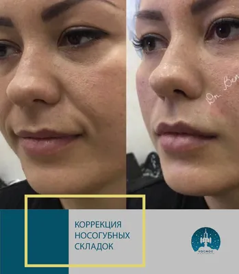Ботулинотерапия лица в косметологии VIP Clinic в Москве. Цены на процедуру  — в прайс-листе