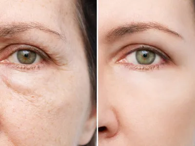The Remarkable Story of Botox