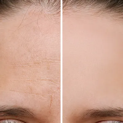 BOTOX Treatments Nashville | Franklin Dermatology Group