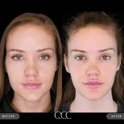 Dysport vs BOTOX® | Which Lasts Longer - Dysport vs BOTOX®?