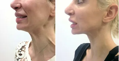 Неудачный ботокс: у девушки перекосилось лицо после укола ботулотоксина в  подбородок