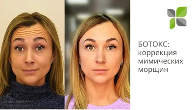 Ботулинотерапия