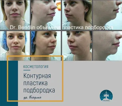 BOTOX //Как убрать морщины лба, морщины межбровья и \"гусиные лапки\" // Ботокс  от морщин: за и против - YouTube