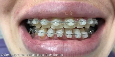 Брекеты Damon статья пациентам «DENTAL PROGRESS»