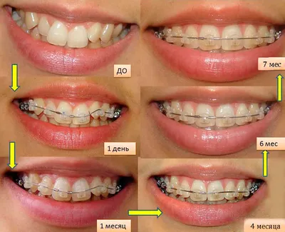 Брекеты фото до и после сроки фотографии