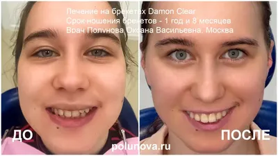 Как меняется лицо после брекетов и элайнеров - клиника Ортодонтика, Москва