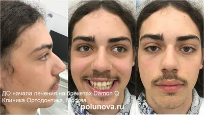 Глубокий прикус - исправление на брекетах Damon Q с фото до и после,  клиника Ортодонтика, Москва