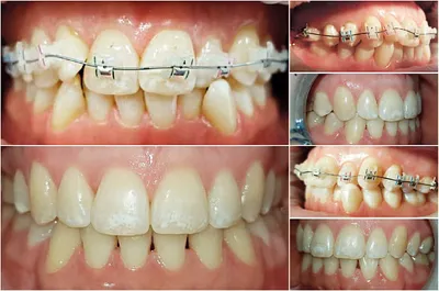 Исправление прикуса (до/после)