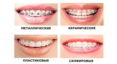 Ортодонтия: Брекет - системы на зубы - Стоматология «Галактика» в  Екатеринбурге