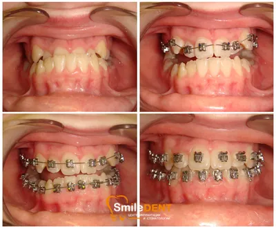 Снятие брекетов с зубов — как снимают, что носят после снятия, можно ли  снять раньше в статье Startsmile