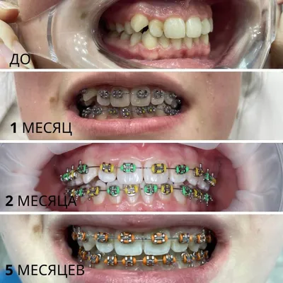 Поставить металлические брекеты в Омске по доступным ценам - стоматология  \"Жемчужный слон\"
