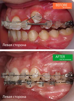 Идеальное ортодонтическое лечение - это брекеты без удаления зубов!  Обращайтесь к ортодонтам вовремя!
