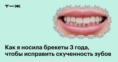 Как долго исправлять дистальный прикус брекетами – ортодонт Полунова Оксана  Васильевна, Москва