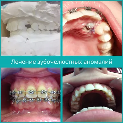 Лечение микрогнатии челюстей на брекетах Damon Q | Клиника Ортодонтика,  Москва