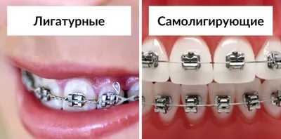 Брекеты вседа надо ставить высоко! - интересно об ортодонтии, имплантации и  протезировании зубов