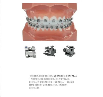 Выравнивание зубов брекетами у взрослых и детей, отзывы, цена доступная в  клинике VITART