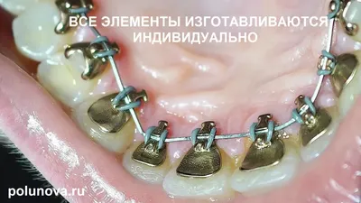 Брекеты. Установка брекетов в Нижнем Новгороде. | DENTALROOM