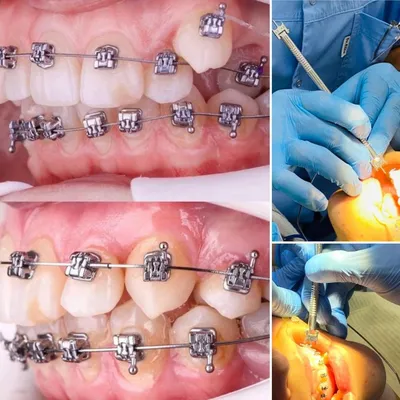 Брекеты - стоимость услуги Ортодонтия — выравнивание зубов в Киеве, Брекеты  - цена в стоматологии lipinskii.com.ua