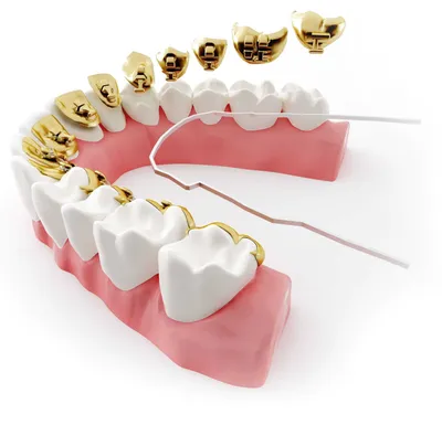 Этапы установки брекетов в Минске