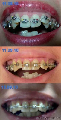 1 месяц в брекетах- зубы двигаются со страшной скоростью!:) | Дневник  пользователя Эн | Брекет.Info