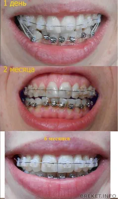 6 месяцев. Результаты | Дневник пользователя Малина | Брекет.Info