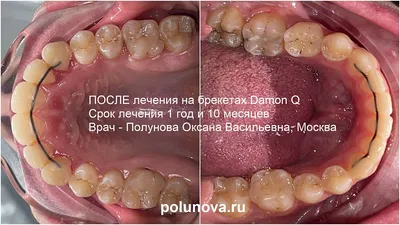 Итог лечения открытого прикуса в клинике Полный Порядок: до и после, сроки,  цена, детальное фото