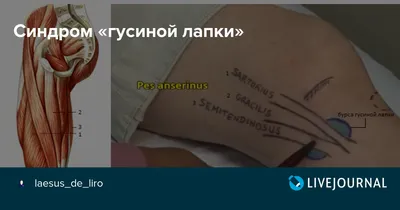 Анзериновый бурсит, также известный как бурсит «гусиной лапки» - это  воспалительное заболевание сумки объединенного сухожилия тонкой, портняжной  и... | By MBSTrus | Facebook